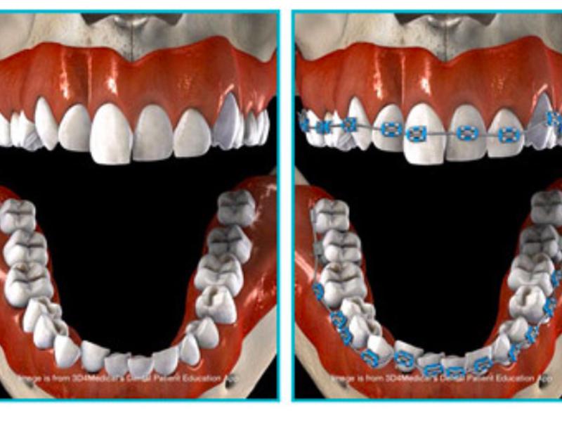Diş Teli ve 20 Yaş Dişleri