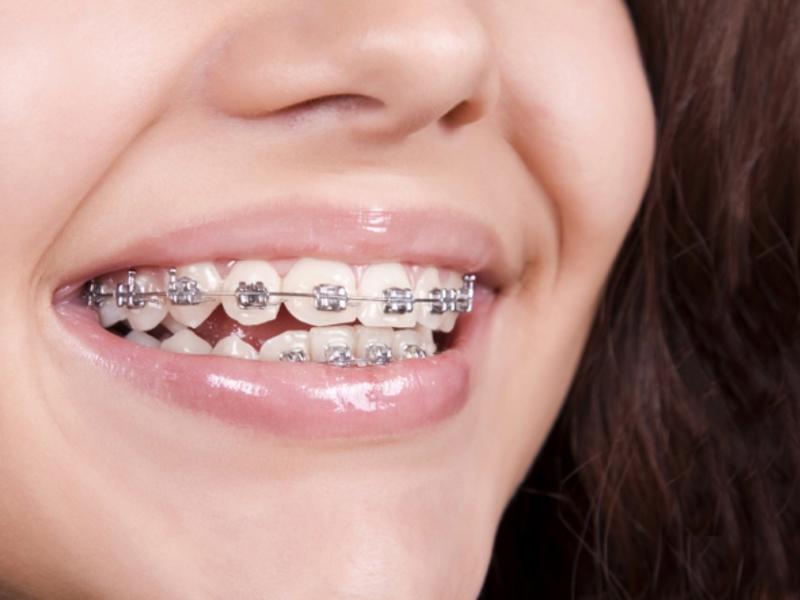 Diş Telleri ile Gülüşünüz Taçlansın