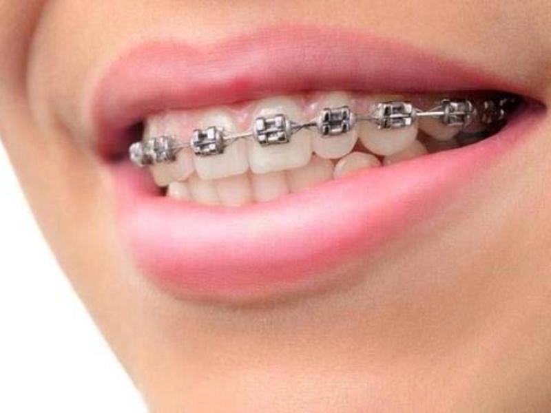 Diş Tellerim Erken Çıkarılabilir Mi?