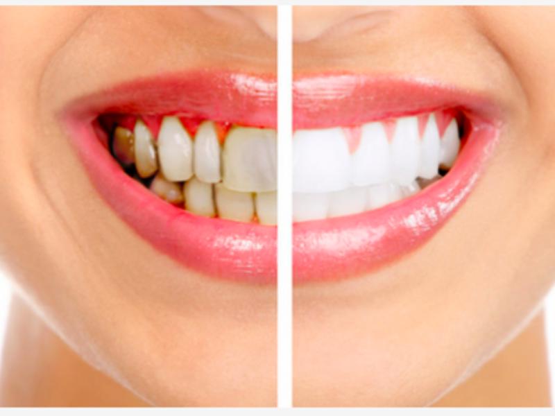 Dişler Neden Sararır?