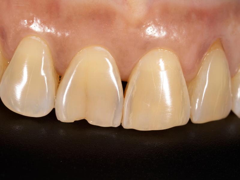 Dişteki Lekeler Nasıl Geçer?