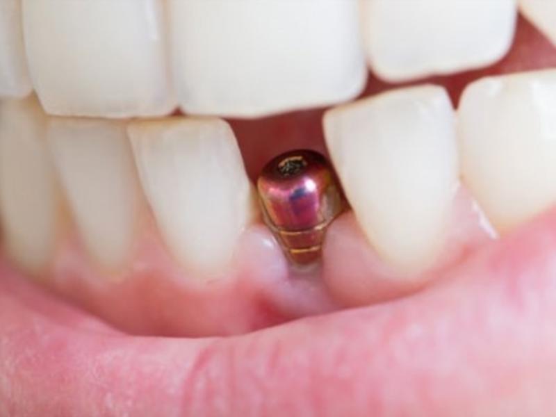 İmplant Diş Telinden Önce Mi Yapılır?