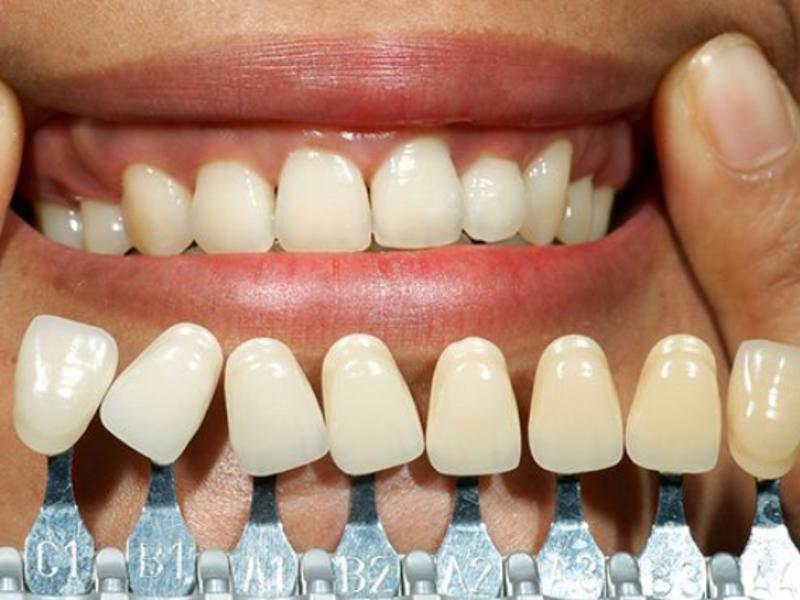 İmplanta Dair Herşey Ve İmplant Fiyatları