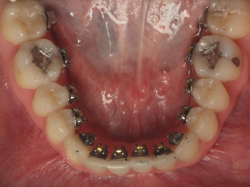Lingual ortodonti