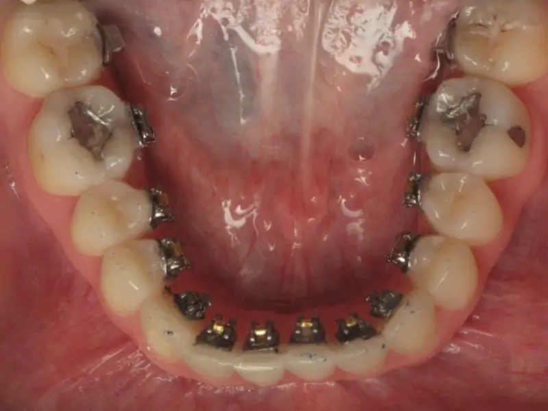 Lingual Ortodonti Nedir?