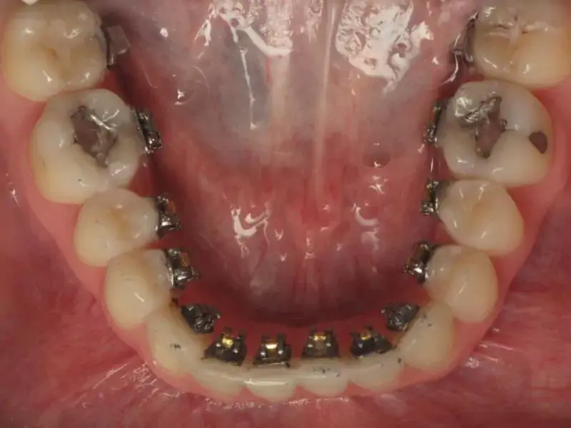 Lingual ortodonti