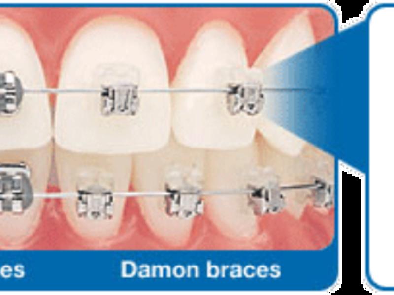Ortodonti dişlerle ilgili tüm estetik problemleri çözer mi