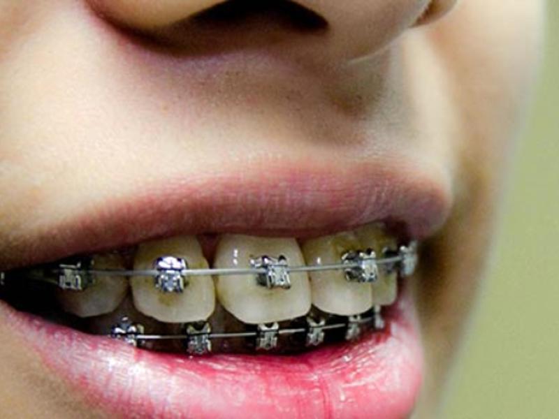 Ortodonti Sürecinde Bilinmesi Önemli Noktalar