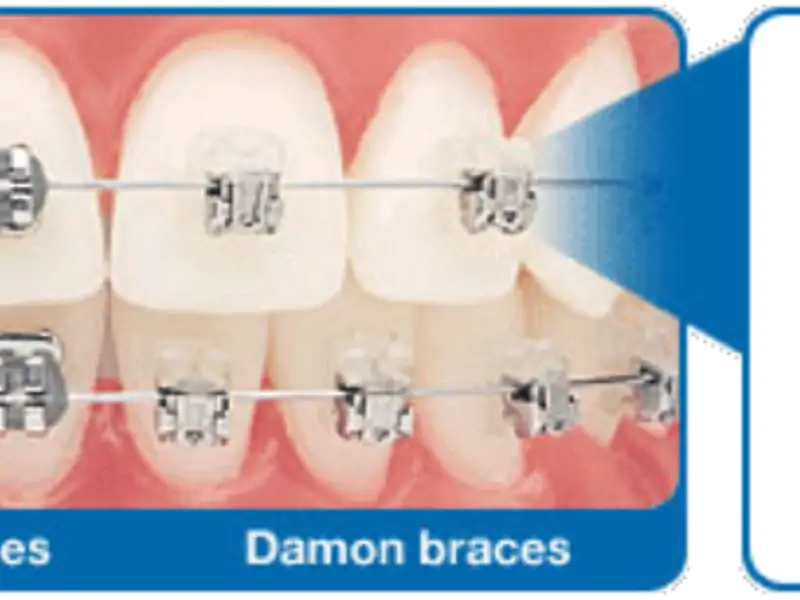Ortodonti tedavisinde damon braketler