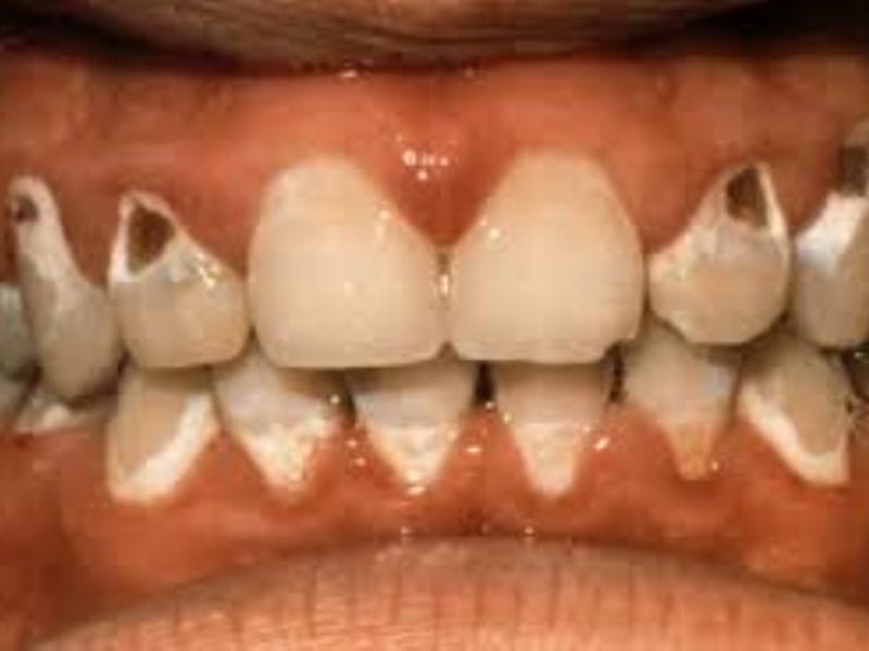 Ortodonti tedavisinde diş fırçalama