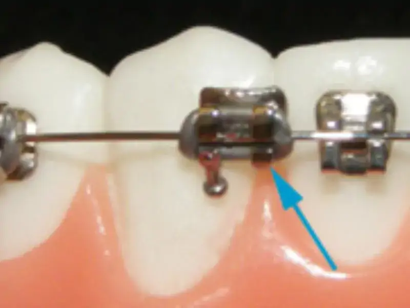 Ortodonti tedavisinde nelere dikkat etmeliyiz