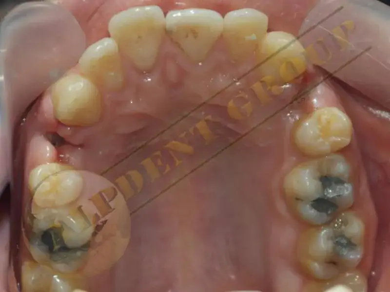 Ortodonti tedavisinde sağlam dişi çekmek doğru mu