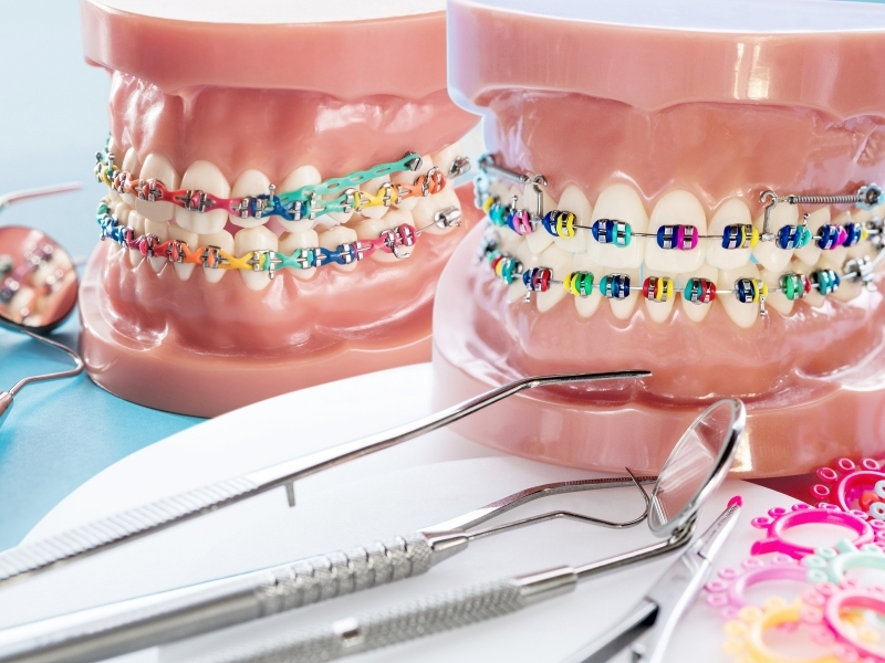 Ortodontik Tedavilerde Kontrol Sıklığı Nasıl Olur?