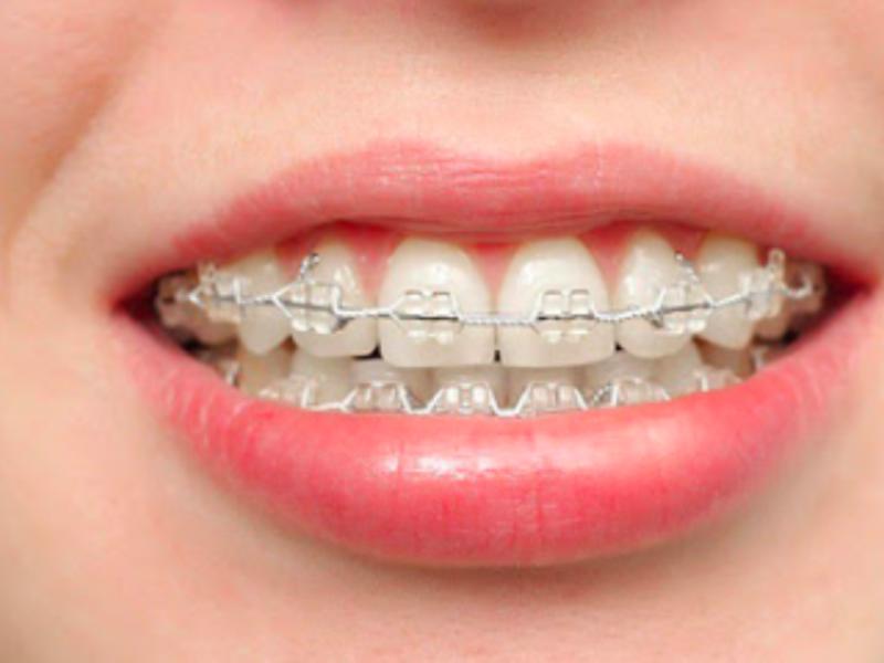 Porselen Diş Teli Kullanabilir Miyim?