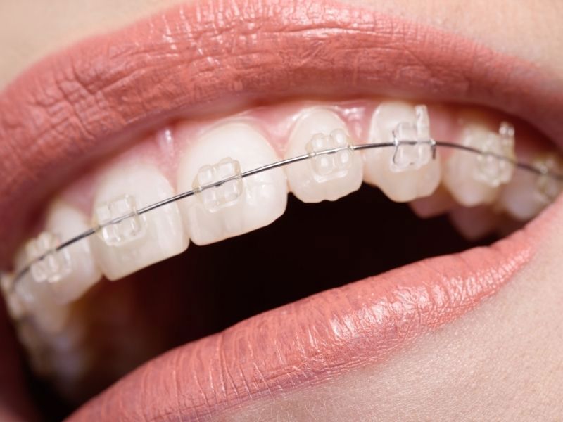 Sadece Üst Diş Teli Fiyatları