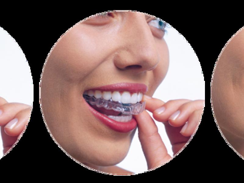 Şeffaf Diş Teli Nasıl Kullanılır