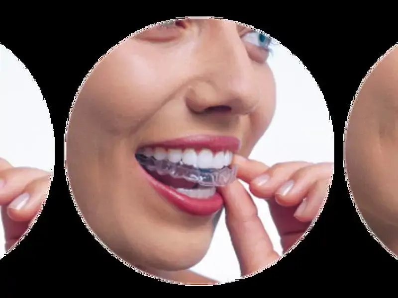 Şeffaf Diş Teli Nasıl Kullanılır