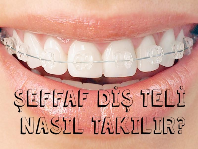 Şeffaf Diş Teli Nasıl Takılır?