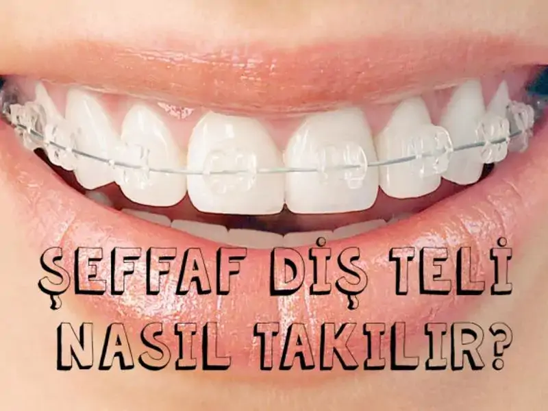 Şeffaf Diş Teli Nasıl Takılır?