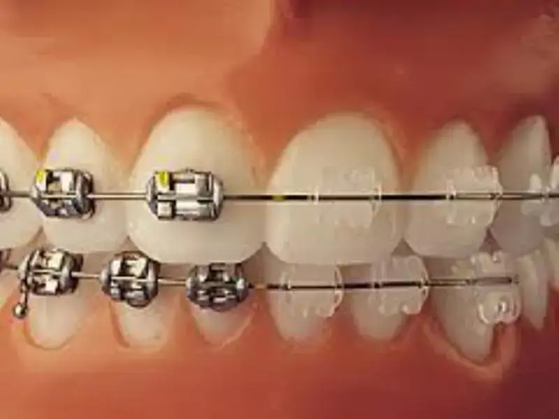 Şeffaf diş telinin metal diş telinden farkı nedir