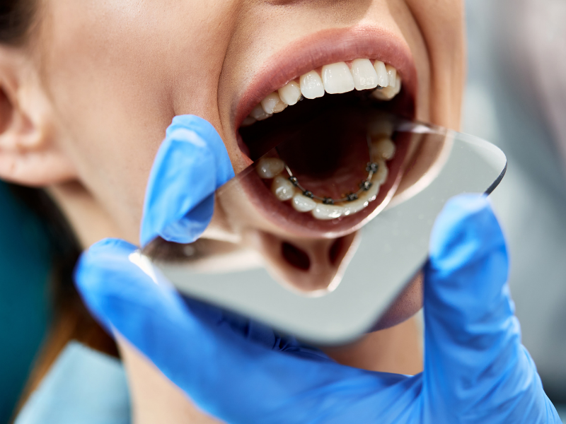 lingual diş telleri