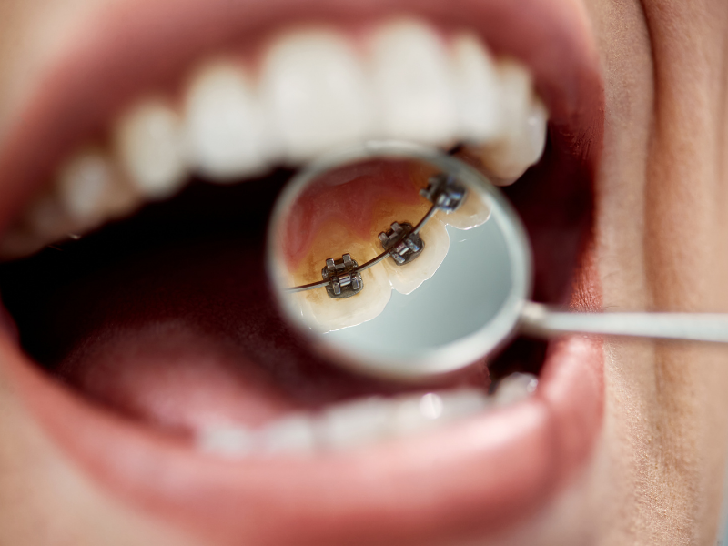 lingual diş telleri